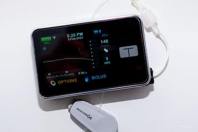 The Benefits of Using an Insulin Pump with a Continuous Glucose Monitor (CGM)